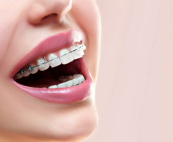 Invisalign® - Maida Vale Dental Practice | Dentist in Maida Vale, London